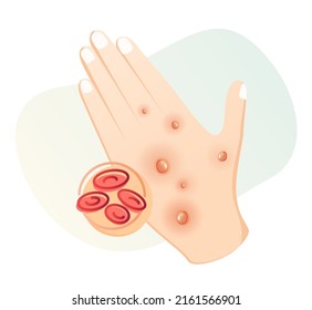 Monkeypox - Skin Rashes and Spots as Symptoms - Icon as EPS 10 File