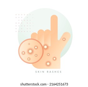 Monkeypox - Skin Rashes and Spots as Symptoms - Icon as EPS 10 File