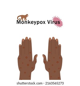 Monkeypox. Ilustración vectorial del nuevo virus 2022 - monkeypox. La viruela que se transmite de los simios a los humanos. Ilustración de manos con erupción de viruela.