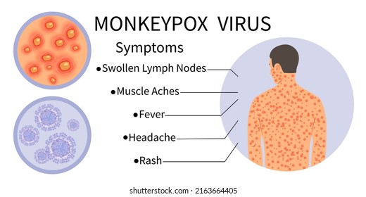 Monkeypox Virus Banner For Symptom Awareness. Monkeypox Virus Symptoms Infographic. Human Body With Rash. Symptoms Of The Disease - Swollen Lymph Nodes, Muscle Aches, Fever, Headache, Rash.Vector.