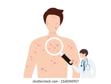 Monkeypox virus concept, human suffering with rashes on all body. New orthopox virus outbreak pandemic spreading vector illustration