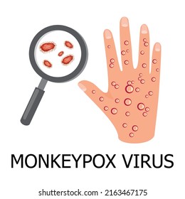 Monkeypox virus concept illustration. Hand with rash from monkeypox virus. Lupe with virus cells. Medical concept. 