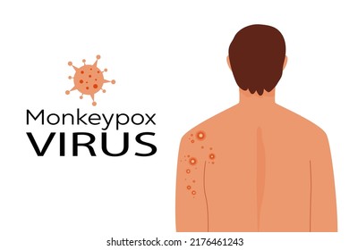 Monkeypox virus concept. Monkey pox banner. Male back affected by blistering rash, scars. Color flat vector illustration isolated on white background