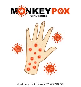 Monkeypox virus design, Vector illustration, New cases of Monkeypox virus are reported in Europe and USA.