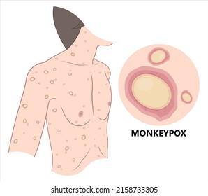 Monkeypox virus genus rash spots body skin Scabs zoonoses sick Transmission outbreak rats mice life cycle