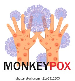 Monkeypox virus. Human hands with a rash on a microbiological background with text. Monkeypox concept. Vector illustration.