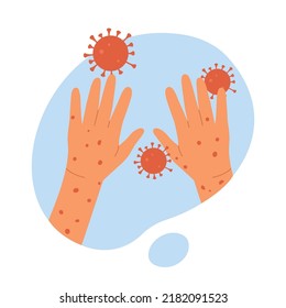 Monkeypox Virus. Human Hands With Monkeypox. Skin Infection Concept. An Outbreak Of A Smallpox Pandemic. Vector Illustration In Cartoon Style. Isolated On White Background.