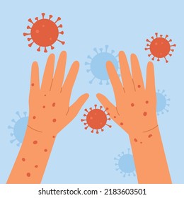 Monkeypox Virus. Human Hands With Monkeypox. Skin Infection Concept. An Outbreak Of A Smallpox Pandemic. Vector Illustration In Cartoon Style. Isolated On Blue Background.