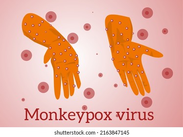Monkeypox virus Illustration, vector of Hands with monkeypox, monkeypox virus outbreak pandemic design with microscopic view background