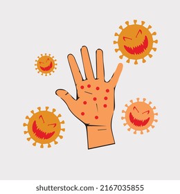 Monkeypox virus with an infected hand