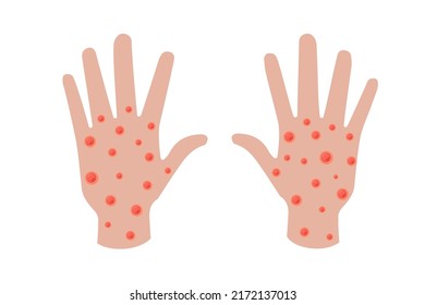 Monkeypox virus infection on hand banner concept. Monkey pox disease outbreak blisters and rash on hand skin. MPV MPVX danger and public health epidemic risk. Vector eps illness symptom illustration