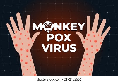 Monkeypox virus infection on hand banner concept. Monkey pox disease outbreak blisters and rash on arm skin. MPV MPVX danger and public health epidemic risk. Smallpox illness symptom. Vector