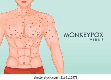 Monkeypox Virus new disease dangerous over the world.