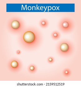 Monkeypox virus on skin, Vector
