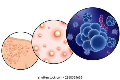 Monkeypox virus outbreak as an infection on the skin, Vector
