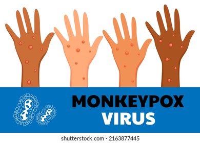 Monkeypox Virus Poster. Web Banner Of Monkey Pox Skin Infection Of Person. Vector Illustration.