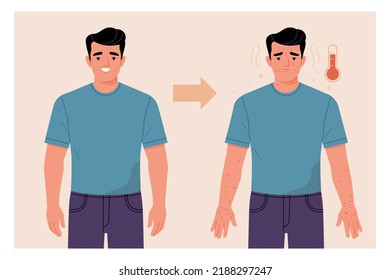 Monkeypox Virus Symptoms concept. Vector cartoon illustration of a young healthy, smiling man, and the same sad sick man with a rash on his body. Isolated on background