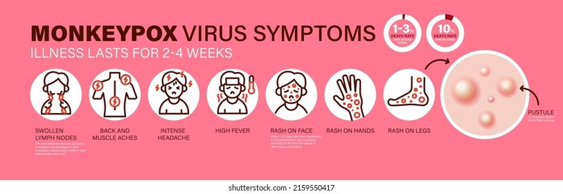 Síntomas del virus de la varicela. Se reportan nuevos casos de virus Monkeypox en Europa y Estados Unidos. La varicela se está propagando en Europa. Causa infecciones cutáneas. Virus Monkeypox Infografía de síntomas