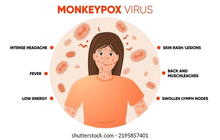 Monkeypox virus symptoms simple infographic. Poster for social media, articles and flyers. Vector illustration.