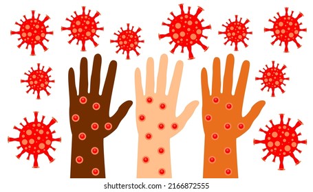 Monkeypox virus, Three human hands of different skin colors in smallpox ulcers. Smallpox monkeys. Vector illustration