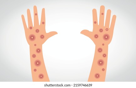 Monkeypox virus. Vectorial monkeypox virus on hand and arm.