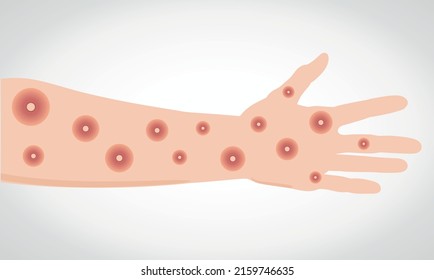 Monkeypox virus. Wounds on the hand and arm. Vectorial