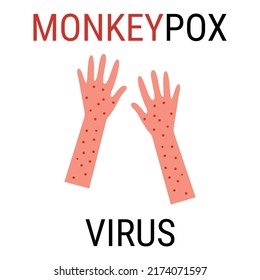 Monkeypox virus zoonotic viral disease that can infect human, nonhuman primates. Monkey pox. Vector illustration
