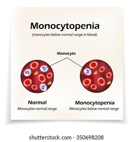 Monocytes below the normal range in the blood. Monocytopenia. Vector illustration.