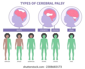 Monoplegia Child tremors arm leg in Cerebral palsy dyskinetic or diplegia quadriplegia Hemiplegia Triplegia of Parkinson's and bell's body Fetal Stiff damage birth motor Gene physical Infant head