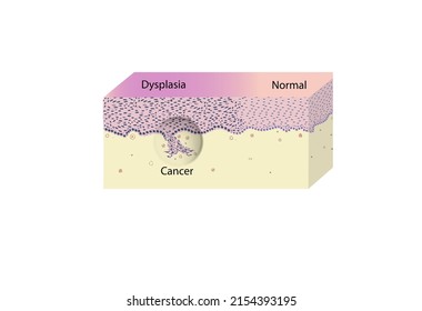 morphology of cervical cancer and dysplasia under a microscope, illustration, vector, eps
