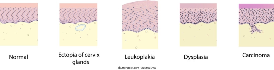 Morphologie der Gebärmutterpathologie unter einem Mikroskop, Illustration, Vektorgrafik