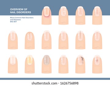 Most Common Nail Disorders and Diseases. Big set. Vector illustration