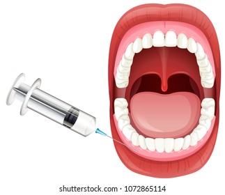 Mouth Anatomy showing Gum Injection illustration