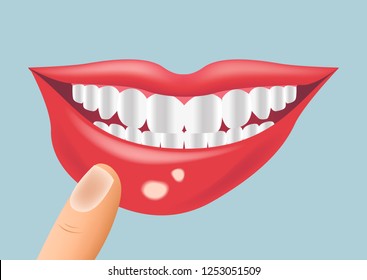 mouth aphtha vector / aphthous