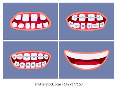 Mouth before and after using dental braces. Teeth corrective treatment. Medical care. Sad and happily smiling. Vector cartoon flat style illustration on a colored background.