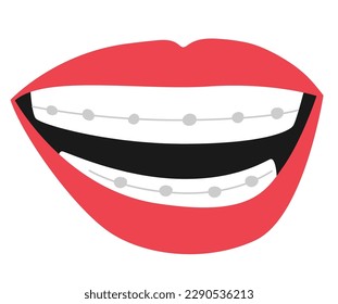 Mouth With Braces Features A Beautiful Smile Adorned With Metal Brackets And Wires That Straighten Teeth And Improve Dental Health Isolated On White Background. Cartoon Vector Illustration