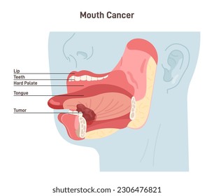 Mouth cancer. Malignant inflammation of oral cavity. Tongue carcinoma. Dangerous effect of cigarette smoking. Flat vector illustration