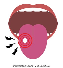 Mouth with canker sore on tongue. Oral health vector illustration isolated on white background.