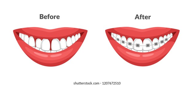 Mouth With Dental Braces. Before and After Corrective Orthodontics. Dentistry Vector Illustration 