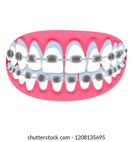 Mouth With Dental Braces.  Corrective Orthodontics. Dentistry Vector Illustration