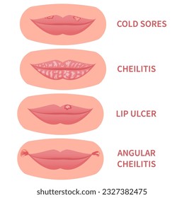 Mouth disease medical set. Cold sores and angular cheilitis with cracked corners. Lips ulcer inflamation with cracking and peeling skin. Dermatitis outbreak. Medical concept. Vector illustration.