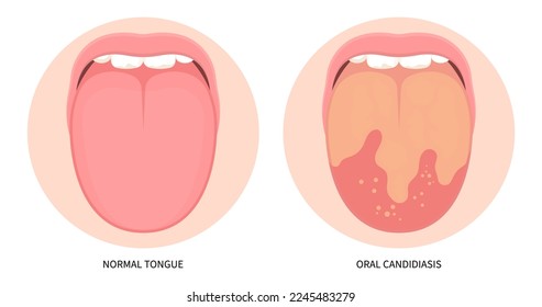 Mouth fungal throat tonsils inflamed cancer ulcer swelling oral pain angular canker sore viral pink trauma burnt gums dry of hunter median celiac iron virus B12 anemia immune system red fever