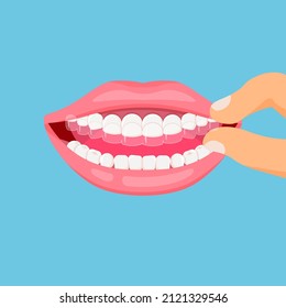 Mouth guard. Teeth with transparent braces. Alignment of teeth by aligners. Orthodontic dentistry concept. Dental care. Vector illustration isolated on blue background.