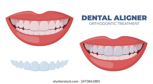 Protector bucal. Dientes con tirantes transparentes. Alineación de dientes por alineadores. Entrenador de silicona de ortodoncia. Alineador de llaves invisibles, retenedor. Vector