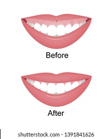 Mouth With A High Smile Line Or Gummy Smile Before And After The Orthotropics, Orthotropics Or Botox Injections Correction. Vector Illustration