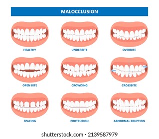 Vorderansicht häufige Typen von Bissproblemen Zähne oder Kiefer falsch ausgerichtet
