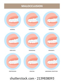 mouth open deep bad bite teeth gum Joint pain jaw surgery corrective bone oral smile Lower Weak Chin health extra Spacing Anterior fixed