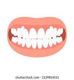 mouth open deep bad bite teeth gum Joint pain jaw surgery corrective bone oral smile Lower Weak Chin health extra Spacing Anterior fixed