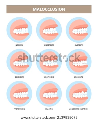 mouth open deep bad bite teeth gum Joint pain jaw surgery corrective bone oral smile Lower Weak Chin health extra Spacing Anterior fixed
