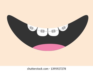 Mouth with tooth braces and tongue. Smiling face. Healthy teeth brace. Body part. Cute cartoon character. Oral dental hygiene Children teeth care icon. Baby background. Flat design Vector illustration